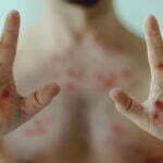 Paraná registra mais sete casos confirmados de Monkeypox