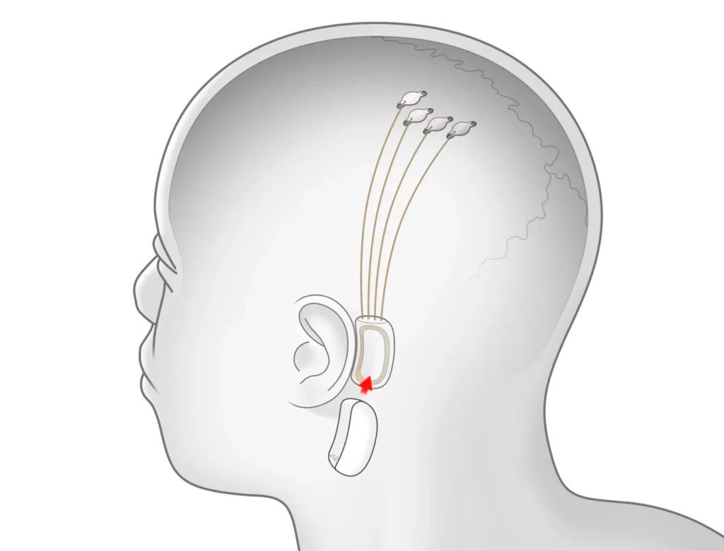 Neuralink — Empresa de Elon Musk, recebe aprovação para fazer testes com implantes cerebrais em humanos 2 A Neuralink empresa de implantes cerebrais de Elon Musk
