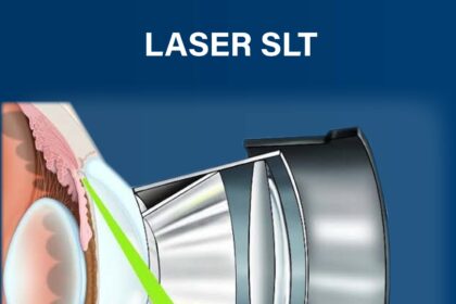 Laser SLT é utilizado no tratamento do glaucoma