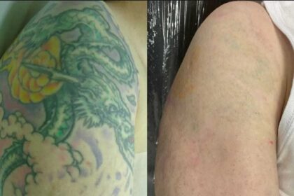 Brasil é segundo país em pesquisa sobre remoção de tatuagem