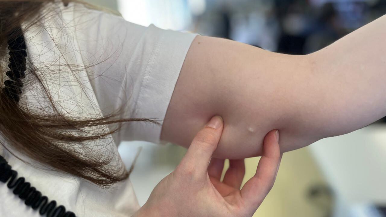 implante contraceptivo