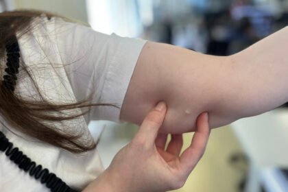 implante contraceptivo