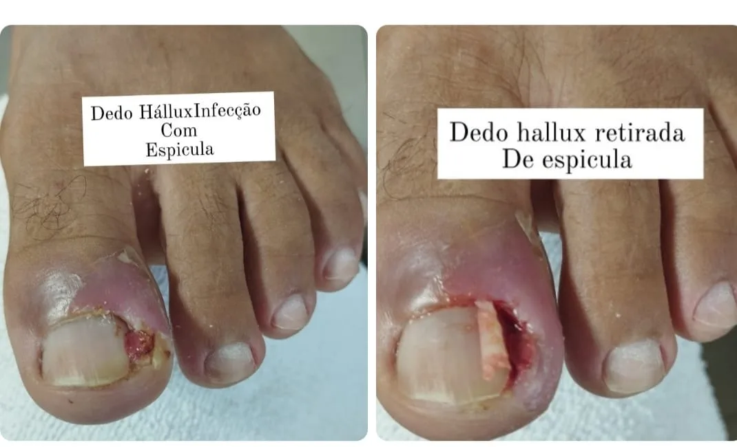 Como evitar que a sua unha fique encravada 2 WhatsApp Image 2025 06 15 at 16.53.35